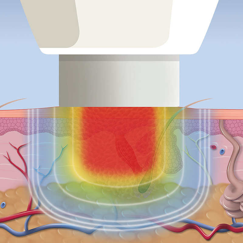 Swift® Verruca Treatment